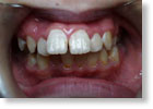 出っ歯症例1