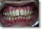 出っ歯症例3