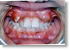 乱杭歯症例1