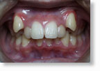 乱杭歯症例2