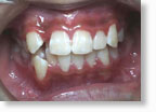 乱杭歯症例3