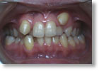 乱杭歯症例4
