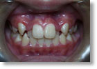 乱杭歯症例5
